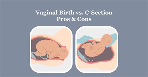  Discussing the Pros and Cons of Vaginal Breech Birth 