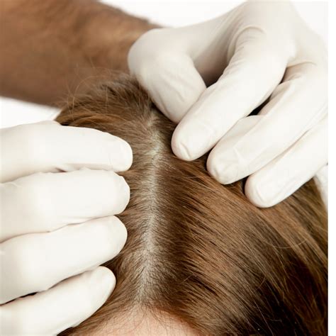  Expert Tips: Maintaining Optimal Scalp Health to Combat Stubborn Flakes