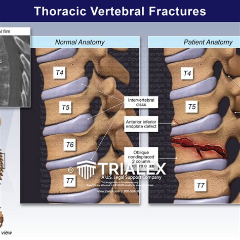  Exploring the Psychological Interpretations of Dreaming about a Fractured Thoracic Bone 