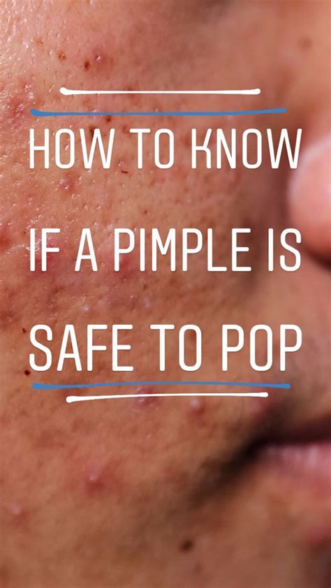  Is it Safe to Pop a Pimple? Expert Insights and Precautions 