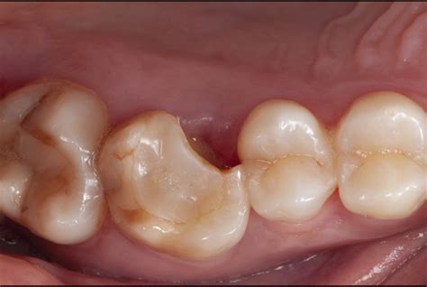  Techniques for analyzing and deciphering a dream concerning a fractured molar 