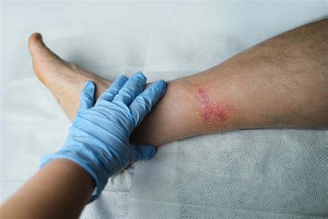  Tips for Avoiding Dreams Involving Pus-Infected Wounds 