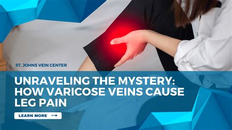  Unraveling the Mystery: What are Spider Veins? 