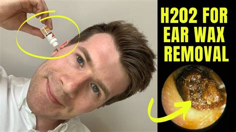  Using Hydrogen Peroxide to Safely Remove Ear Wax 