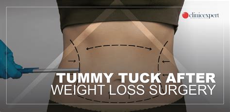 Achieve Your Ideal Weight: The Role of a Tummy Tuck in Weight Loss