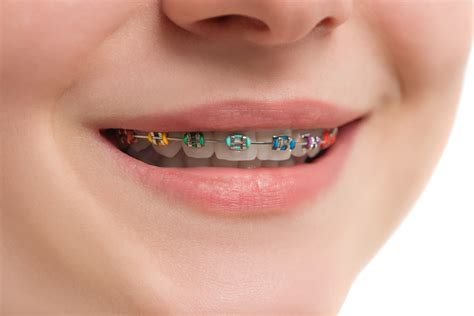 Achieving the Ideal Smile: Making Your Brace-Filled Wish Come True