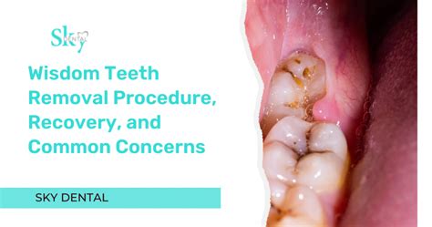 Addressing Common Concerns about Wisdom Teeth Extraction