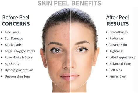 Advantages of Facial Peels for Glowing Complexion