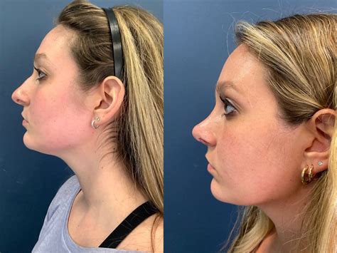 After Rhinoplasty: Recovery and Results