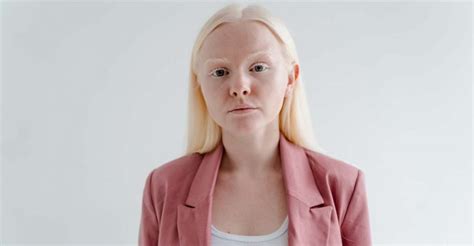 Albino Dreams: A Glimpse into the Intriguing Subconscious