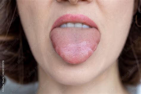 Allergic Reactions: A Culprit Behind Tongue Inflammation