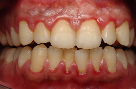 Allergic Reactions: Unexpected Causes of Gum Swelling