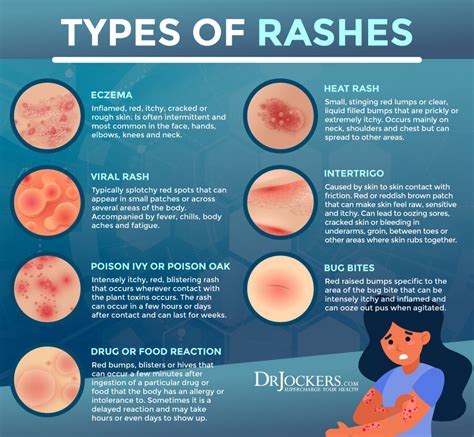 Allergic Reactions and Rashes: Identifying and Managing Skin Irritations