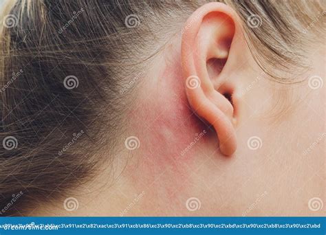 Allergic Reactions and Swelling of the Ear: Essential Information