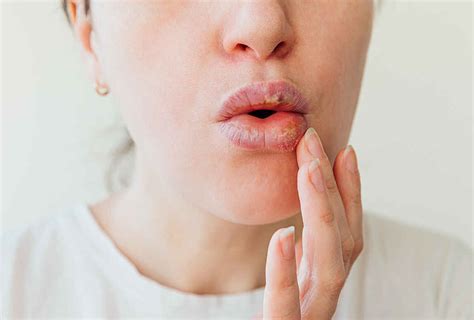 Allergies and Swollen Lips: Common Triggers