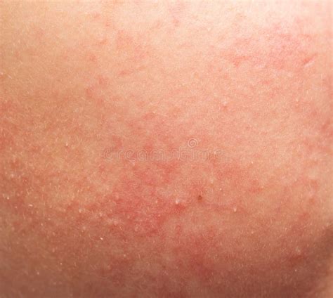 Allergies and their role in skin irritation