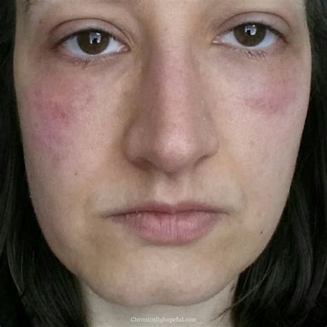 Allergy-Induced Facial Reactions: Under the Veil of Dreams