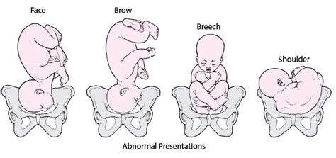 An Exploration of the Symbolism Behind Dreams of an Abnormal Baby Position