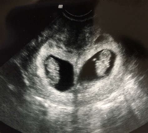 An Unforgettable Moment: Witnessing the Miraculous Sight of Twins on the Ultrasound