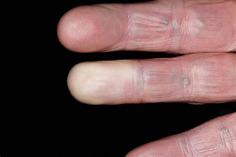 An Unusual Phenomenon Explained: Blemishes on the Fingertips