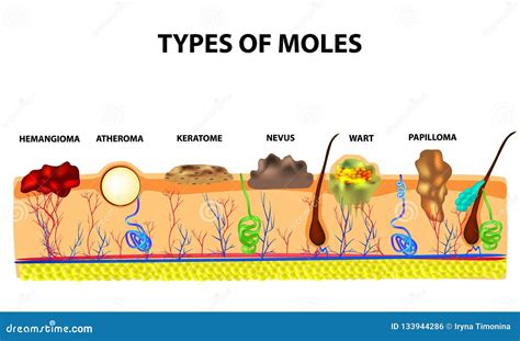 Analyzing Different Types of Moles in Dreams