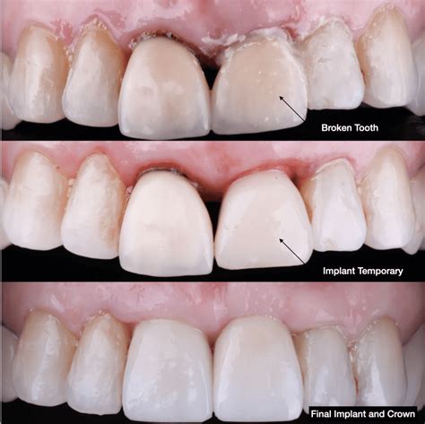 Analyzing Personal Experiences: Insights from Individuals Who've Experienced a Cracked Front Tooth in their Dreams