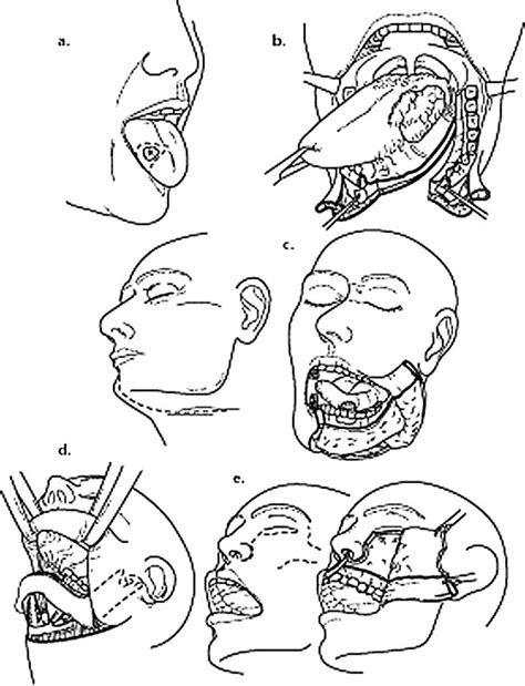 Approaching the Analysis of Suds in Oral Cavity Visions: Insightful Approaches and Techniques