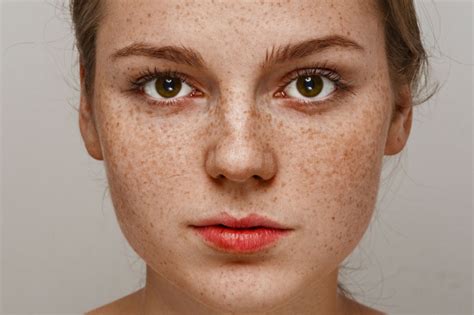 Are Freckles Inherited or Developed?