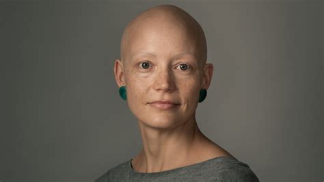 Baldness as a Representation of Vulnerability