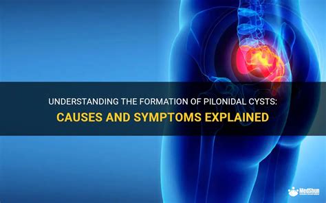 Behind the Scenes: Understanding the Formation of Large Cysts