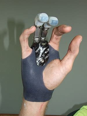 Beyond Prosthetics: Bioengineering a Functional Extra Thumb