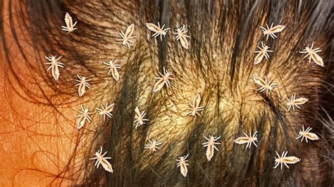 Beyond Scalp and Fur: Bizarre Cases of Oversized Lice Infestations in Unusual Hosts