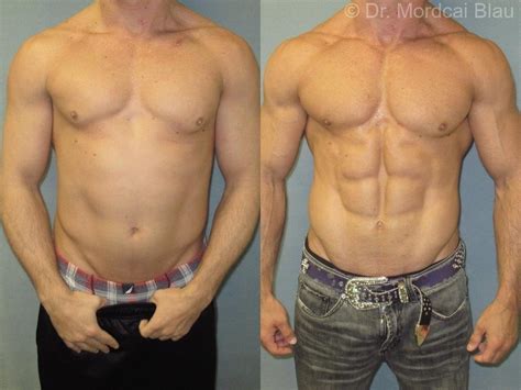 Body Transformation Trends: From Cosmetic Surgery to Bodybuilding