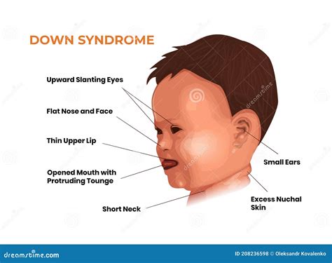 Breaking Down Barriers: Overcoming Challenges Faced by Families with a Child with Trisomy 21