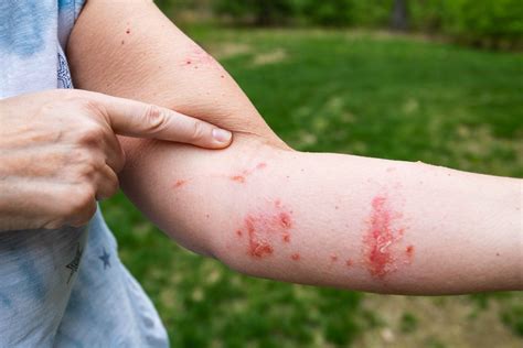 Breaking Down Symptoms of Poison Ivy Rash