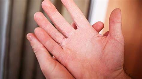 Causes of Dry Hands and How to Prevent Them