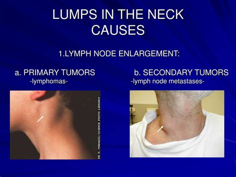 Causes of Formation of a Lump on the Dorsal Region