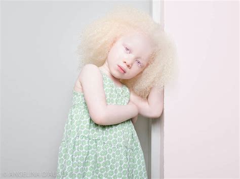 Celebrating the Beauty and Influence of Albinistic Visions