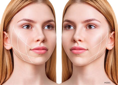 Choosing Between Traditional Face Lift and Mini Face Lift: Finding the Perfect Fit