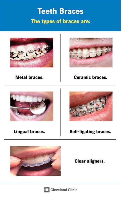 Choosing the Right Braces: Options and Considerations