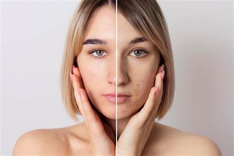 Choosing the Right Products: Key Considerations for Acne Treatment