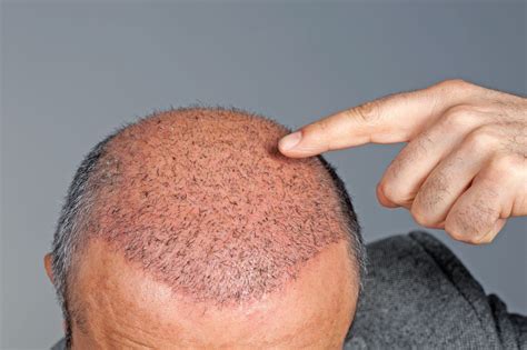 Choosing the Right Technique for Hair Restoration