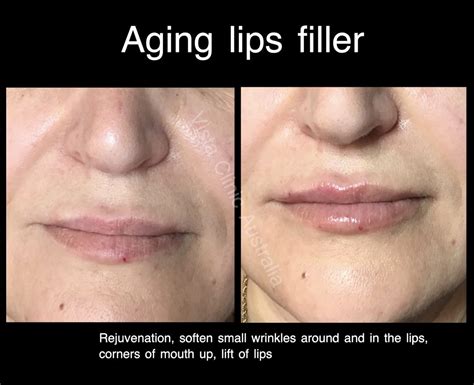 Common Concerns: Thin Lips and Aging