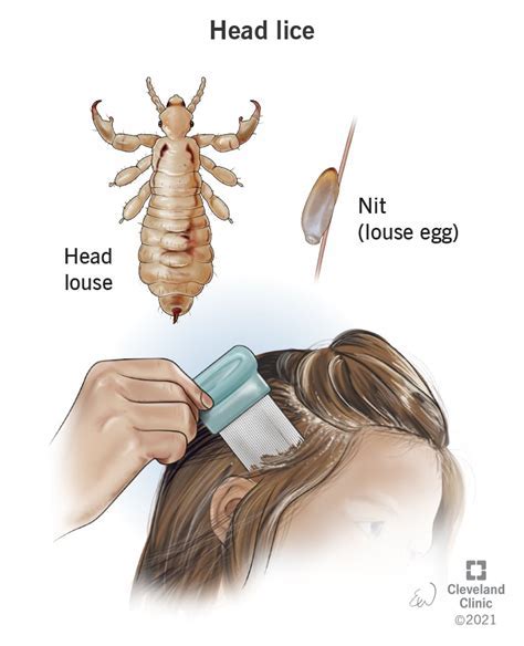 Common Dream Scenarios Involving Lice on the Head