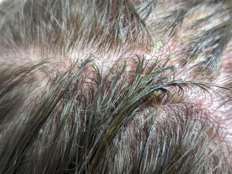 Common Dream Scenarios of Pustules on the Scalp and their Significance