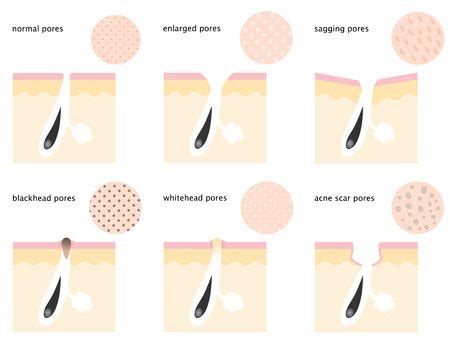 Common Factors Leading to Enlarged Pores and Imperfections of the Epidermis