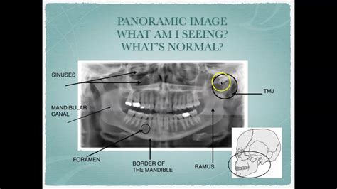 Common Interpretations and Significance of Faux Dental Vision