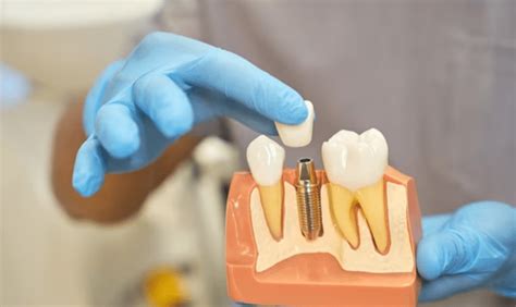 Common Mistakes to Avoid for Optimal Dental Health