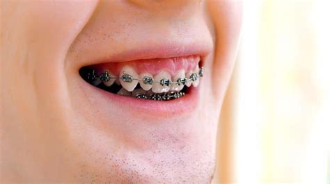 Common Myths and Misconceptions about Dental Braces