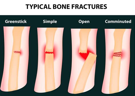 Common Themes Associated with Dreams of a Fractured Piercing